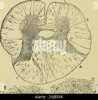 Un manuel des maladies du système nerveux . des lieux où l'axe-cylindre est enflée, thisappears beaucoup plus grande que la normale (Fig. 93, V). Des exemples de ceci relâche être trouvés dans la plupart des chiffres. Ces intenses degenerativechanges causer la rupture de la myéline, et peut impliquer l'thedestruction de la fibre, l'espace occupé par celle-ci étant laissée vide. * L'importance de ce discnssed vacuolisation a été beaucoup. Il est probablethat^ forme vacuoles après la mort, peut-être pendant le processus de durcissement, butthat ihey ne forment pas à moins que les cellules ont été altérés par la maladie. Thussome ils ont pa Banque D'Images