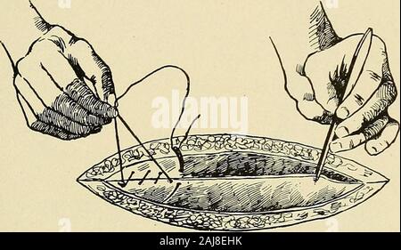 L'assistant de chirurgie, un manuel pour les étudiants, les praticiens hospitaliers, médecins et infirmières . Fig. 51. Bords de coaptation par traction avec deux forceps. premier dans une main jusqu'à ce que tous les assistants les sutures de thatrow sont en place. L'adaptation de l'intro- bords lors de la suture. 143 d'un surjet est maintenu par le assistantby maintenant tendu l'extrémité proximale (mauvais) fin de l'émergence de la thread nearits-tissus, de les libérer, pour sécuriser un newhold, comme la prochaine suture est tiré vers le bas sur la ligne de l'Union européenne(Fig. 52). Le dernier nœud d'un surjet est madeby laissant le Banque D'Images