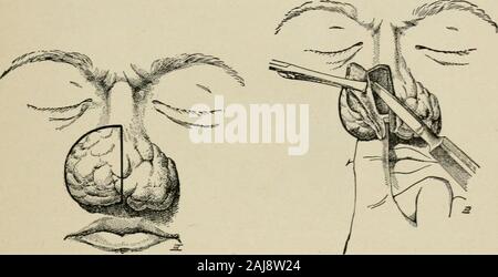 La chirurgie plastique ; ses principes et pratiques . throughwhich incision kin l'os incisions sont faites avec achisel. Les pointillés indiquent le boneincisions. Cela peut être fait sur bothsides si nécessaire. L'acné (Rhynophyma Hypertrophica) pour les difformités de l'acnehy pertrophicaradical, le recours à des mesures chirurgicales sont nécessaires. Placer le doigt dans la narine DE LA CHIRURGIE DU NEZ EXTERNE 433 et de l'accise l'ensemble jusqu'à la croissance du cartilage. Althoughsevere purge peut facilement être vérifié. La peau à la narine de marge devrait beconserved aussi loin que possible pour éviter le contrat subséquent Banque D'Images