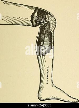 Travaux préparatoires et après le traitement dans le cas du dispositif . Fig. 417.-Appareil pour ThighStump. Dans PartialFlexion au genou. Banque D'Images