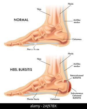 Une illustration médicale d'un pied sain et un talon pied touchés par une bursite. Banque D'Images