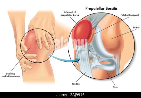 Medical illustration anatomie de bursite prepatellar état du genou humain. Banque D'Images