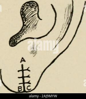 La chirurgie plastique ; ses principes et pratiques . Fig. 398. pour la correction des défauts lobulaire.-i. Les lignes en pointillé indiquent pour theincisions la suppression de la marge de l'anomalie cicatricielle SAC. 2. Les points B andC sont approximatives et la plaie est fermée. Banque D'Images