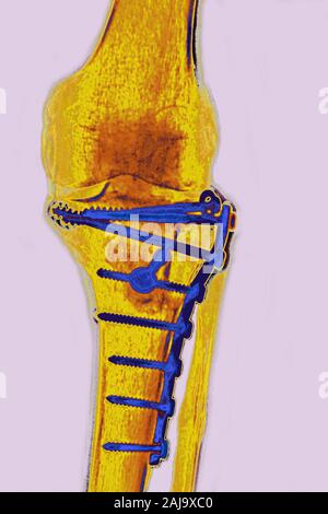 Sur le tibia d'ostéosynthèse Banque D'Images