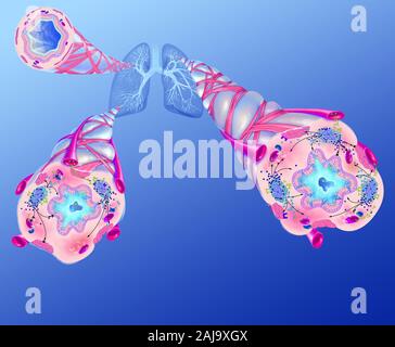 L'asthme et de ses traitements pour prévenir l'obstruction des voies aériennes. Représentation des poumons avec l'arbre bronchique à partir de laquelle 3 zooms. Dans le coin supérieur gauche, un sain, ci-dessous, deux bronchioles bronchioles asthmatiques. Un allergène (étoile verte) déclenche l'asthme par l'activation de lymphocytes produisant des IgE (Y) verte menant à de la dégranulation des mastocytes (mauve) qui libèrent les leucotriènes (perles) et des cytokines (perles bleues) médiateurs de l'inflammation de la muqueuse, ce qui entraîne une bronchoconstriction de fibres musculaires lisses, l'hypersécrétion de mucus et l'obstruction des voies respiratoires. Banque D'Images
