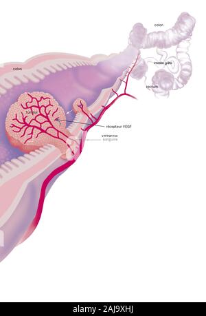 Le cancer colorectal Banque D'Images