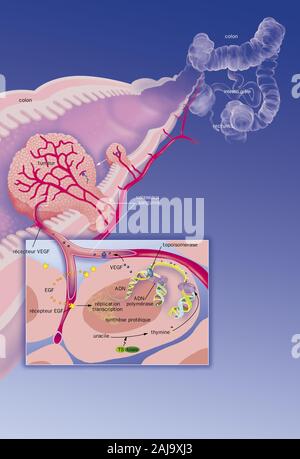 Le cancer colorectal Banque D'Images