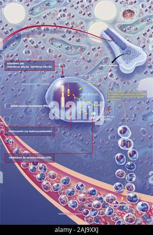 Leucémie myéloïde chronique, cml Banque D'Images