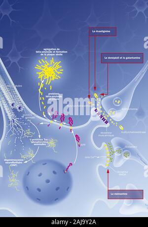 Processus de dégénérescence neurofibrillaire avec neurone, plaque sénile, des traitements. Neurone dans le système nerveux central affectées par clivage anormal de l'APP Banque D'Images