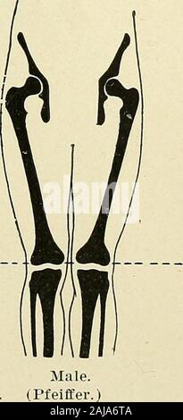 Un traité sur la chirurgie orthopédique . Femme^.inclinaison normale des fémurs légèrement incliné vers l'intérieur. pour les genoux, formant un angle à theknee, qui ouvrent vers l'extérieur, d'environ 172 degrés. Cet angle varieswith l'étendue du bassin, et c'est, par conséquent, moins dans adultfemales que chez les mâles (Fig. 398 et 399). Le con-dyle du fémur est légèrement plus long que l'externe ; ainsi, l'Orthopédie 602 SUBGEBT. Inclinaison du fémur est compensée et le plan de joint-theknee est horizontale, symptômes.^-Lorsque la projection vers l'intérieur des genoux est en-pliées pour un degré notable la ti Banque D'Images