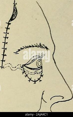 La chirurgie plastique ; ses principes et pratiques . Fig. 353.-fonctionnement des moines pour la restauration d'une paupière, suite.- i. Trappe d'Drawingthe à travers le tunnel. 2. Le volet suturé dans le vice et les incisions fermée.Les lignes en pointillé indiquent la position du navire, et du pédicule navires dans la trappe. pocket est faite, qui a l'esquisse du projet de Rabat. L'skinside de la poche est bordée d'un seul greffe, qui Ollier-Thiersch-tours sur le bord. Après dix jours, la croissance est enlevé avec le nécessaire.^  --^^ v Banque D'Images