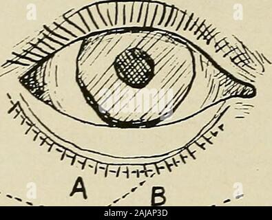 La chirurgie plastique ; ses principes et pratiques . Fig. 347.-Tweedys opération pour l'ectropion (barbe, dans le bois).-i. Le dottedlines indiquent que les incisions. Le volet A, y compris une section de la conjonctive et d'tarsusabout 0,8 cm. (Environ 3-3 pouces) de large est relevé. L'ectropion est corrigée par la dissection de la peau le long de l'incision upthe B. 2. Le volet A est ensuite déplacée dans ce défaut et suturé.s'il est nécessaire d'utiliser l'extrémité de la muqueuse sur la fin de la trappe pour fermer le défaut, il peut être retiré par la suite. Je 372 CHIRURGIE PLASTIQUE la trappe coulissante-fonctionnement de Dieffenbach, Harlans,modification et K Banque D'Images