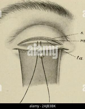 La chirurgie plastique ; ses principes et pratiques . Fig. 325. Fig. 326. Cochon. 325.-opération de Snellen, pour l'entropion (Meller).-A aminci (f.) du tarse est excisé. En place des sutures, s., de la peau ; w., muscle ; ta., tarse. Fig. 326.-opération de Snellen, suite.-section verticale à travers le ixpper couvercle, montrent à l'excision en forme de cuneus (e.) de la tarse {la.), avec la suture (5.) (Meller).. Banque D'Images