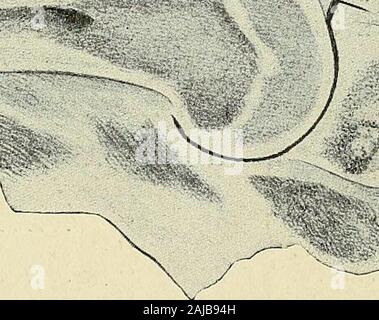 Un traité sur la chirurgie orthopédique . Gonflements douloureux sur les chevilles, en commun surpondérés sujets. Les patients se plaignent généralement de faiblesse et de malaise.Le traitement en plus de la réduction de poids, et de soutien pour l'arche, est affaibli, massage et cerclage des bandages. Theoperative dépose de l'enflure des tissus est indiqué dans obstinatecases. Chapitre XII. Maladies et INJUEIES THEUPPEE OE LES ARTICULATIONS DES EXTEEMITY. La maladie tuberculeuse de l'épaule. Maladie à l'épaule est très rare dans l'enfance. Ina total de 453 cas de tuberculose-maladie traitée à l'Vander-b Banque D'Images