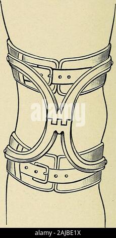 Un traité sur la chirurgie orthopédique . Le Giifflths corset. (Jones.) le patient reconnaissant le caractère des mouvements qui arelikely à provoquer le déplacement, l'manipulationfor aussi son remplacement. Dans d'autres cas un peu comme les symptômes peuvent followinjury au genou, un pincement de la membrane synoviale, bruis-ing ou une fracture du cartilage, ou d'une souche de l'un des liga-ments dans l'articulation, d'être affecté en tant que causes. Dans les cas de ce personnage, dans lequel les symptômes reviennent de temps à autre, thejoint devient faible et précaire, en partie en raison de la réévaluation d'un épanchement synovial tourbé Banque D'Images