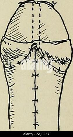 La chirurgie plastique ; ses principes et pratiques . Cochon. 293.-Russells opération pour l'hypospadias, suite.- i et 2. La boucle s'isdrawn dans le canal du gland. 3. La partie de la boucle redondante est enlevé, et les bords sont suturés à la partie dénudée du gland de chaque côté du chenal.Toutes les blessures sont ensuite fermées. la partie redondante est supprimé, et les bords sont suturés avec finehorsehair à la surface dénudée du gland de chaque côté de l'incision, empêchant ainsi les flessum de l'orifice du c. Le woundsare ensuite fermée avec le crin. Une auto-maintien je cathéter Banque D'Images