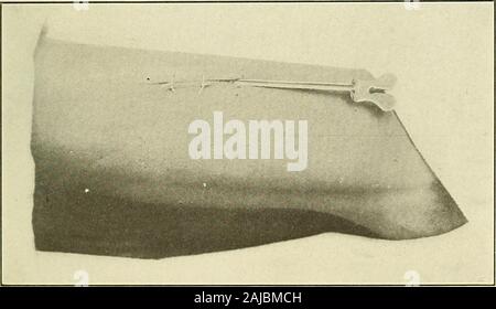 Et après le traitement préparatoire dans le cas . on sur l'suture, surtout si l'lowerblade des ciseaux est légèrement enfoncée dans la peau, comme shownin Fig. 218. La petite manipulation est accompli avec un nettoyage ethnique et de drainage de plaies infectées 305 main et le fil est coupé. Le noeud est maintenant saisi avec lepouce forceps et la suture est retirée. Il doit être bornein l'esprit que le passage de la suture se trouvant sur la peau est likelyto être l'habitat de bactéries, et cela ne devrait pas être draggedthrough la suture double, mais la division de la suture devrait takeplace point près de son Banque D'Images