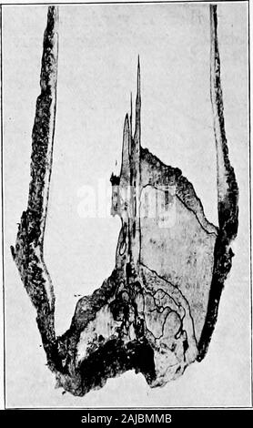 Les maladies et ravageurs de l'arbre à caoutchouc . est foimdin BrownRoot Fomes lignosus ou maladie. Les racines(Fig. 6) L'ours souvent smallblack nodules, deux threemillimeters ou de diamètre, blanc et mayappear whichare interne blanc sur le dessus s'ils ont été endommagés lorsque root a été déterré. Ils sont généralement dispersés, andnot en grand nombre. Ils sont formés par l'emergenceof le mycélium du tissus malades, et, eu l'rootbeen exposés, aurait sans doute développé en fructi-. Dans les cas avancés il y a souvent une mince,continu, couche noire ou croûte sous l'avant-p Banque D'Images