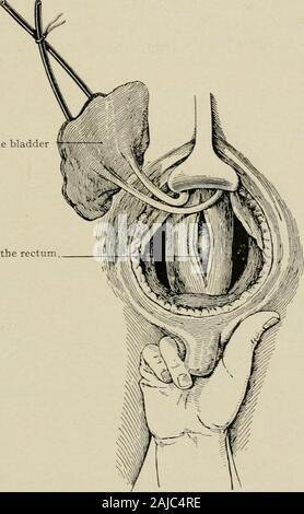 La chirurgie plastique ; ses principes et pratiques . d'éviter d'endommager aussi bien thepossibility à l'uretère, lui-même ou pour ses navires. Dès que la vessie est bien isolé il est tiré vers le haut hors de theway par un assistant. Dans la partie inférieure de la plaie le rectum avec itsperitoneal la réflexion est aujourd'hui considéré. Le péritoine est alors strippedupward à partir de l'avant du rectum jusqu'à 10. ou 12.5cm. (4 ou 5 pouces)de l'intestin sont exposés. Le doigt d'un assistant ayant été passedinto le rectum pour le rendre d'éminents, de traction sont placés et l'extrophie vésicale 303 une incision 8,75 cm. (3I Banque D'Images