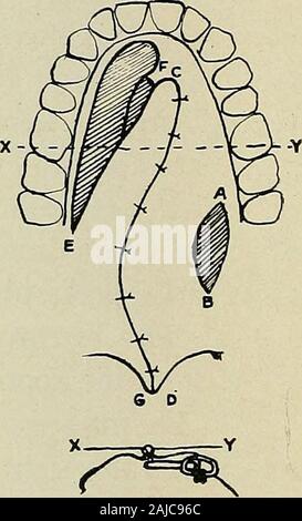 La chirurgie plastique ; ses principes et pratiques . Fig. 253.-La méthode du volet de fermeture d'une fente palatine (Davies-Colley).-i. Le incisionAB avec son centre seulement interne à la dernière molaire est faite jusqu'à l'os dans le palais mou en avantet arrière. Par cette incision le mucoperiosteal isseparated du volet de la moitié postérieure du palais dur. L'incision de CD juste en frontof la fissure et 0,625 cm. (3^ pouce) de sa victoire, s'effectue en arrière, graduallyapproaching la jonction de dur et le palais mou ; les tissus sont desserrés et turnedinward. L'incision doit être con Banque D'Images