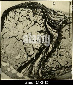 Un traité sur la chirurgie orthopédique . Artliritis proliférative : type extrême. Photomicrographie de throughphalangeal article joint. Les trabécules de les phalanges sont moins nombreux ; thannormal la capsule est légèrement épaissi : la cavité articulaire est beaucoup réduite insize par extension vers l'intérieur du tissu fibreux, dense de la membrane synoviale-à l'endroit indiqué par le cercle : ce pannus fibreux est adhérent à bothJoint les cartilages, produire l'adhésion et la perte de motion sans destruction du cartilage sous-jacent. (Nichols et Richardson.) Fig. 203.. L'arthrite proliférante : type extrême. Vertic Banque D'Images