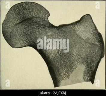 Un traité sur la chirurgie orthopédique . transformation de déformées à la normale quand theimproper de relations et de poids souche ont été supprimés.Wolff première a attiré l'attention sur le fait que la forme d'un boneis l'effet de la fonction. C'est l'effet d'en fonction que si le travail requis d'elle avait été sa forme différente. diftcreut serait ontété Cette fonction a façonné non seulement le externalcontour mais la structure interne. Si un os est brisé, DEFOBMITIES DE LA COLONNE VERTÉBRALE. 241 par exemple, le col du fémur, et difformité résultats, architecture intérieur n'est plus fonction de Banque D'Images