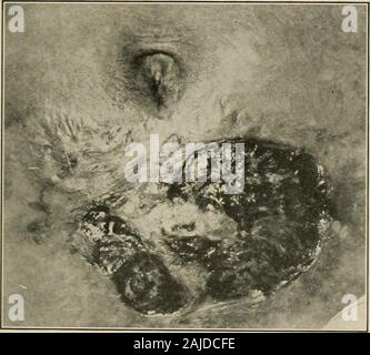 La chirurgie plastique ; ses principes et pratiques . hs.-Cette washealed ulcère dans le service des consultations externes par le traitement local, et se reproduisent pas followedduring a plusieurs années. J'ai eu plusieurs cas dans lesquels une hémorragie grave s'est produite eitherjust avant ou juste après la dépose du marécage. Il beremoved le slough dès que sa différenciation est terminée, et tout devrait insolubles et ulcères VARICES 20I faire pour stimuler la croissance et granulations d'épithélium du bords, comme le processus de guérison est très lent. Le temps peut être savedby l'excision de l'ensemble de la zone suivie Banque D'Images