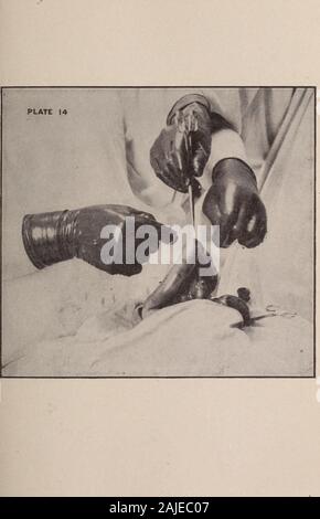 Les transactions de l'Association américaine des obstétriciens et gynécologues pour l'année ... . Étape n° 7.-l'intestin invaginent avec le doigt, separatingthe les surfaces qui sont broyés ensemble. Le coveredwith fabricants l'intestin invaginée est poussée à travers le anastomosingopening. Le gaz sera immédiatement passer de l'un à l'autre de l'intestin. L'OBSTRUCTION DE L'INTESTIN. 109. 12110 MAURICE I. ROSENTHAL 15 PLAQUE Banque D'Images