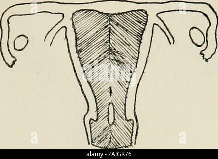 Travaux de la Société médicale de l'État du Connecticut .. . Pia.l. La grossesse DE MALFORMATIONS DE L'UTÉRUS. 175. Banque D'Images