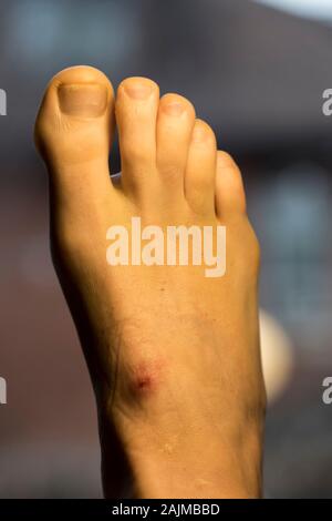 Pied close up avec ulcération d'être dans le plâtre pour la guérison d'une jambe cassée. Peau rouge avec briseur dans le centre. Sur patient avec ulcère du pied jambe cassée. Banque D'Images