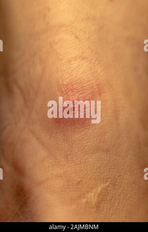 Ulcère cutané close up sur le dessus de pied d'être dans un plâtre. Épiderme dommageables d'un ulcère de pression sur le pied. Escarres close up. Banque D'Images