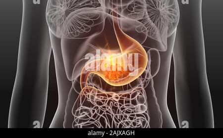 3D illustration montrant le cancer de l'estomac d'une femme Banque D'Images