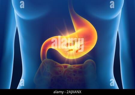 3D Illustration montrant les bactéries Escherichia coli (E. coli) dans l'estomac douloureux, concept médicalement, gastrite Banque D'Images