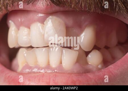 Close-up de très dents de travers dans un barbu adultes. Le droit de ne pas mordre. Pas de dents saines. Violation de la position des dents dans les mâchoires. Den Banque D'Images