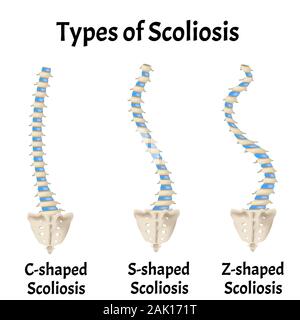 La Scoliose En Forme De S. Dextroscoliosis. Levoscoliosis. La Courbure ...