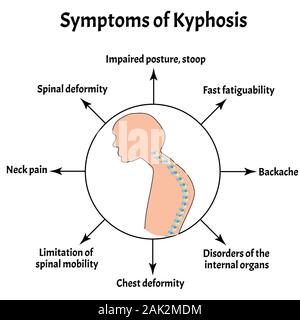 Les symptômes de la cyphose. La courbure de la colonne vertébrale, la scoliose, lordose, cyphose, arthrose. Une mauvaise posture et de Stoop. L'infographie. Vector illustration Illustration de Vecteur