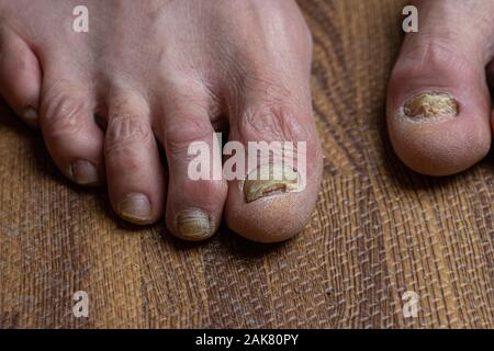 Close up de champignons des pieds et orteils recourbés touchés par la maladie de Parkinson Banque D'Images