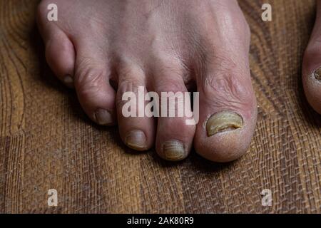 Close up de champignons des pieds et orteils recourbés touchés par la maladie de Parkinson Banque D'Images