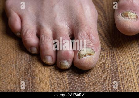 Close up de champignons des pieds et orteils recourbés touchés par la maladie de Parkinson Banque D'Images