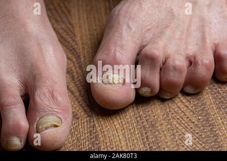 Close up de champignons des pieds et orteils recourbés touchés par la maladie de Parkinson Banque D'Images