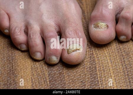 Close up de champignons des pieds et orteils recourbés touchés par la maladie de Parkinson Banque D'Images