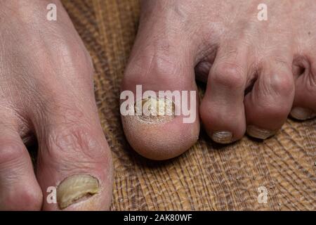 Close up de champignons des pieds et orteils recourbés touchés par la maladie de Parkinson Banque D'Images