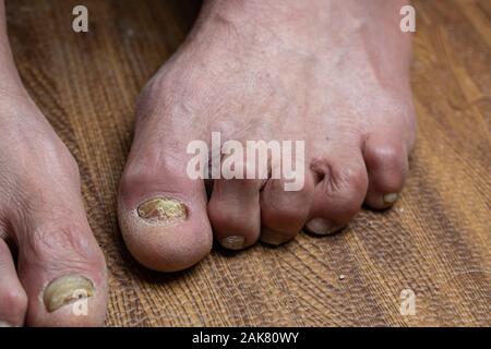 Close up de champignons des pieds et orteils recourbés touchés par la maladie de Parkinson Banque D'Images