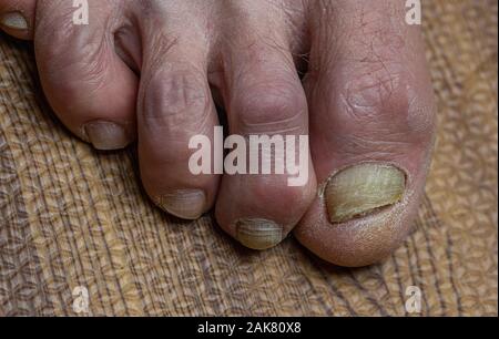 Close up de champignons des pieds et orteils recourbés touchés par la maladie de Parkinson Banque D'Images