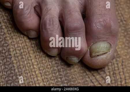 Close up de champignons des pieds et orteils recourbés touchés par la maladie de Parkinson Banque D'Images