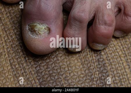 Close up de champignons des pieds et orteils recourbés touchés par la maladie de Parkinson Banque D'Images