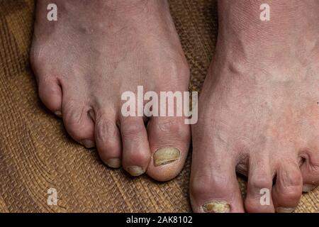 Close up de champignons des pieds et orteils recourbés touchés par la maladie de Parkinson Banque D'Images