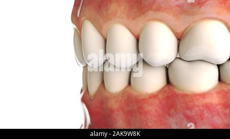 Implant dentaire invisible sur fond blanc - le rendu 3D Banque D'Images