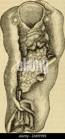 Un manuel des maladies de la gorge et du nez : y compris le pharynx, le larynx, la trachée, l'œsophage, du nez et du pharynx naso-. rowths, chacune entraînant une restriction dans thecanal, quand, en fait, il n'y avait qu'une tumeur.1 Lorsque le massis coupé en, la section est d'un blanc grisâtre ou parfois d'une couleur brun-rouge, et lorsque pressé, donne un jus laiteux. Sur l'ex-microscopiques ce liquide d'amination est constitué de l'agrégation et l'epithe distinctes-lial cellules, et la croissance est composé d'un stroma de fibrillatedtissue, disposés de manière à former des alvéoles de différentes formes et tailles, wit Banque D'Images