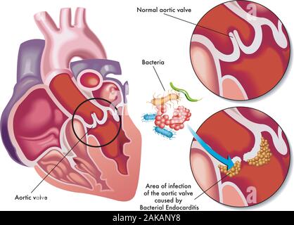 Illustration médicale des symptômes de l'endocardite bactérienne. Illustration de Vecteur
